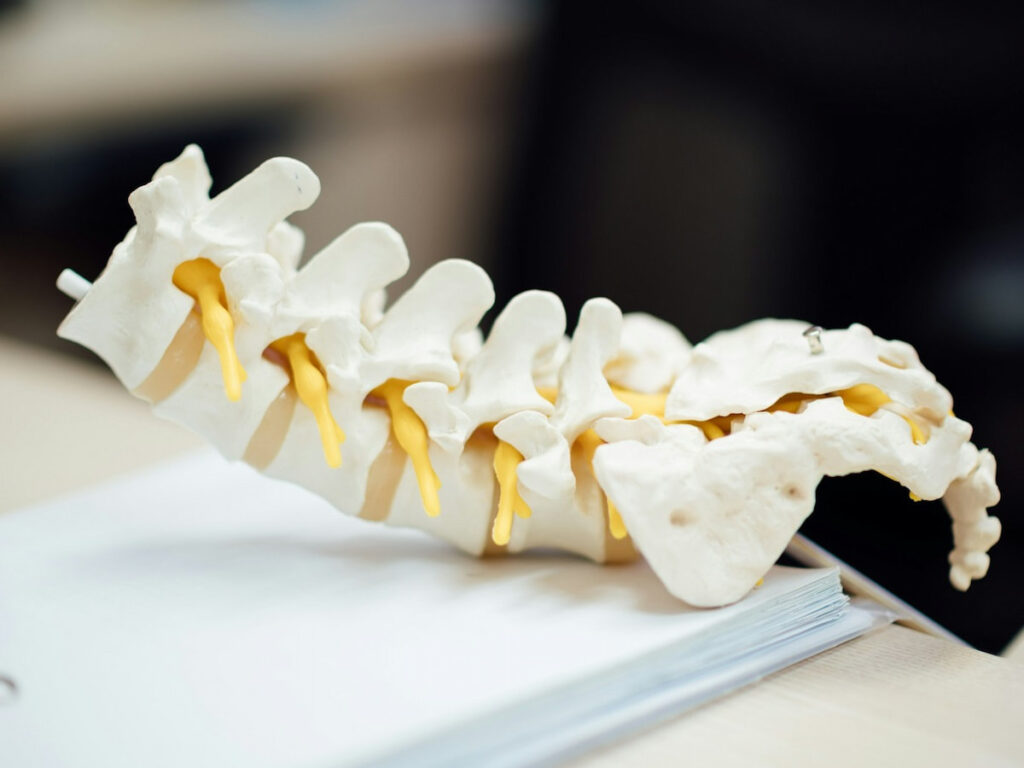 a spine showing the problems of Ankylosing Spondylitis